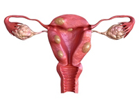 cancer endomètre tunisie cancer endomètre tunisie