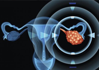 cancer ovaire tunisie